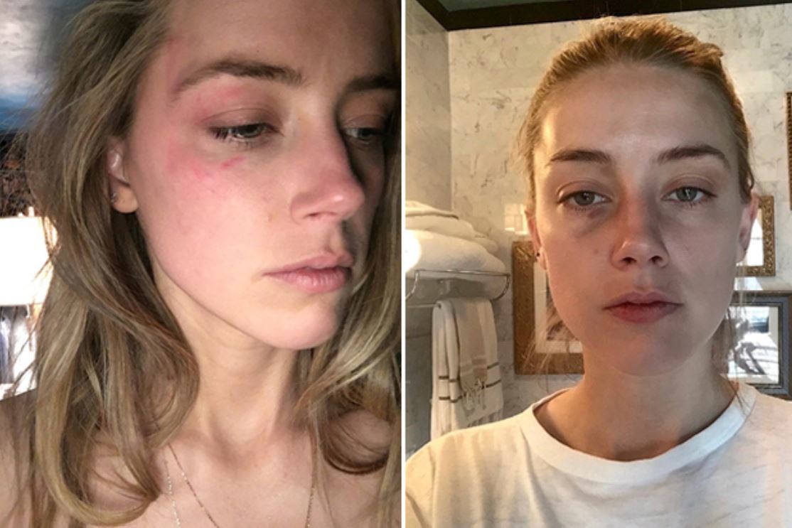 Las fotos que Amber Heard present como prueba de que sufra violencia domstica.