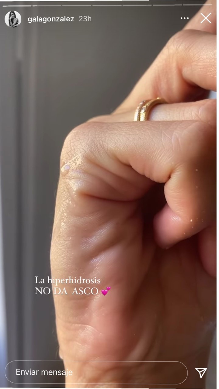 Gala González ha publicado esta imagen de sus manos con hiperhidrosis en las redes sociales.